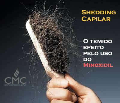 shedding-queda-cabelo-minoxidil