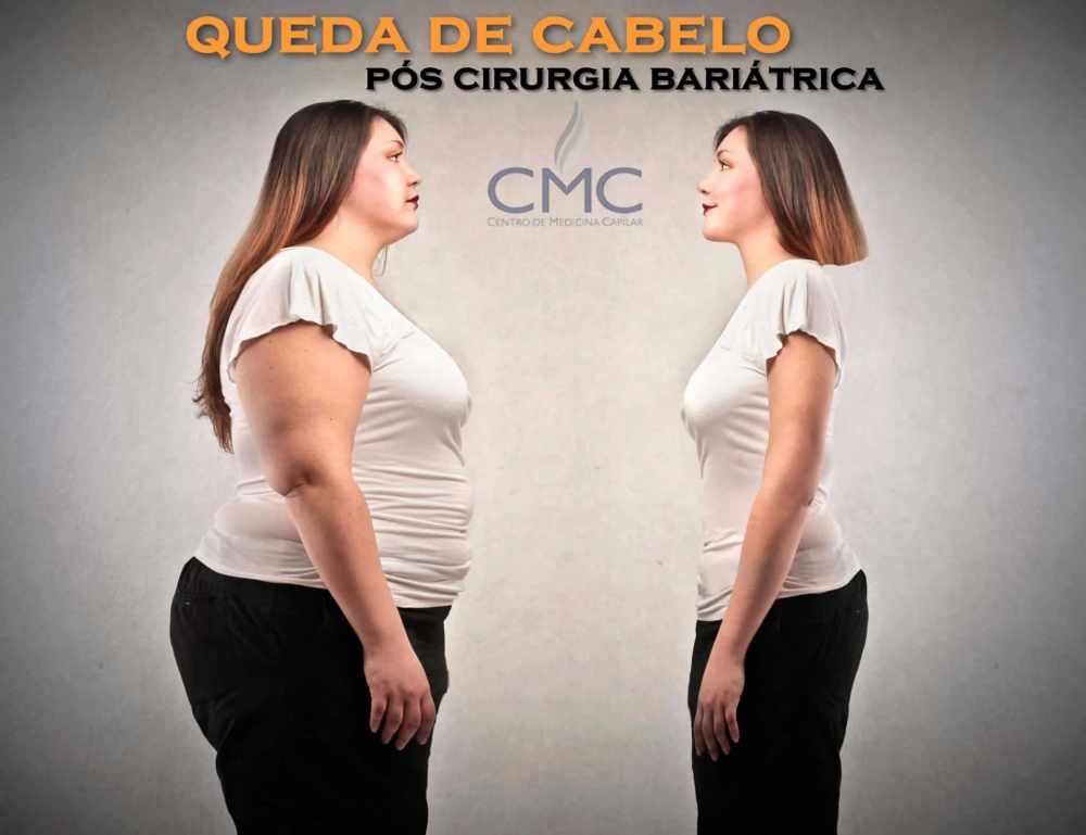 cirurgia bariatrica queda de cabelo